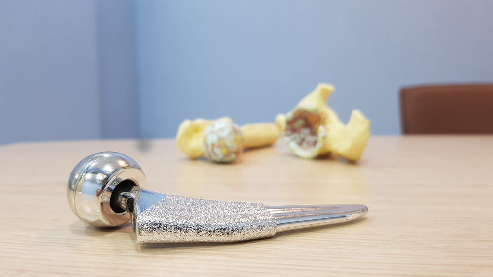 Koliko dugo traje proteza kuka