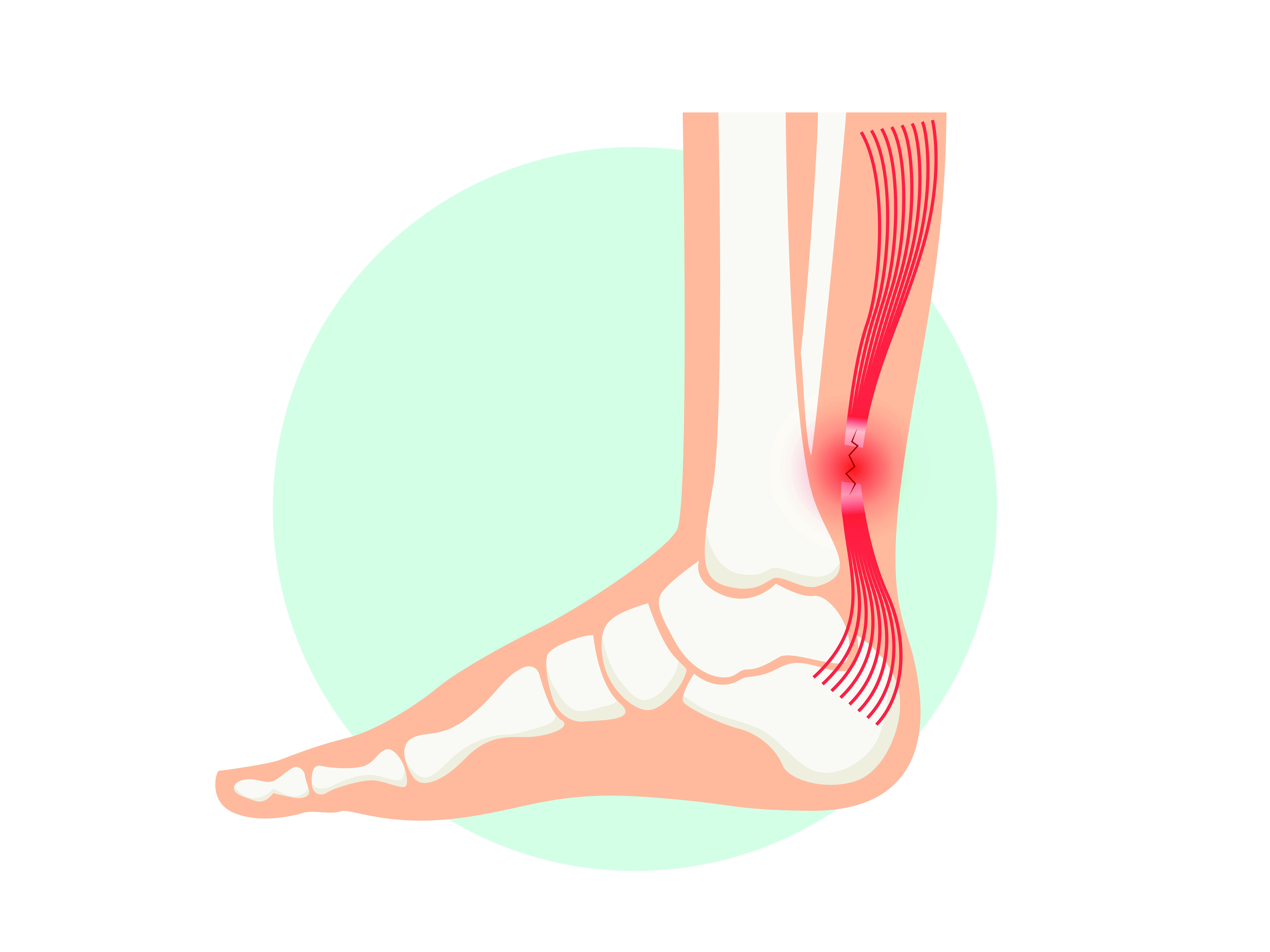 Kako se sprovode različite operacije Ahilove tetive